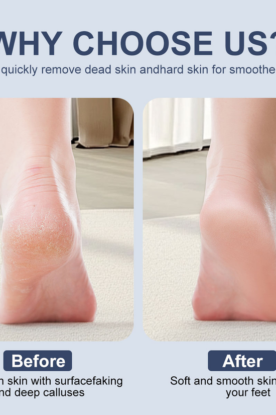 Vacuum Callus Remover – Electric Foot Care Tool