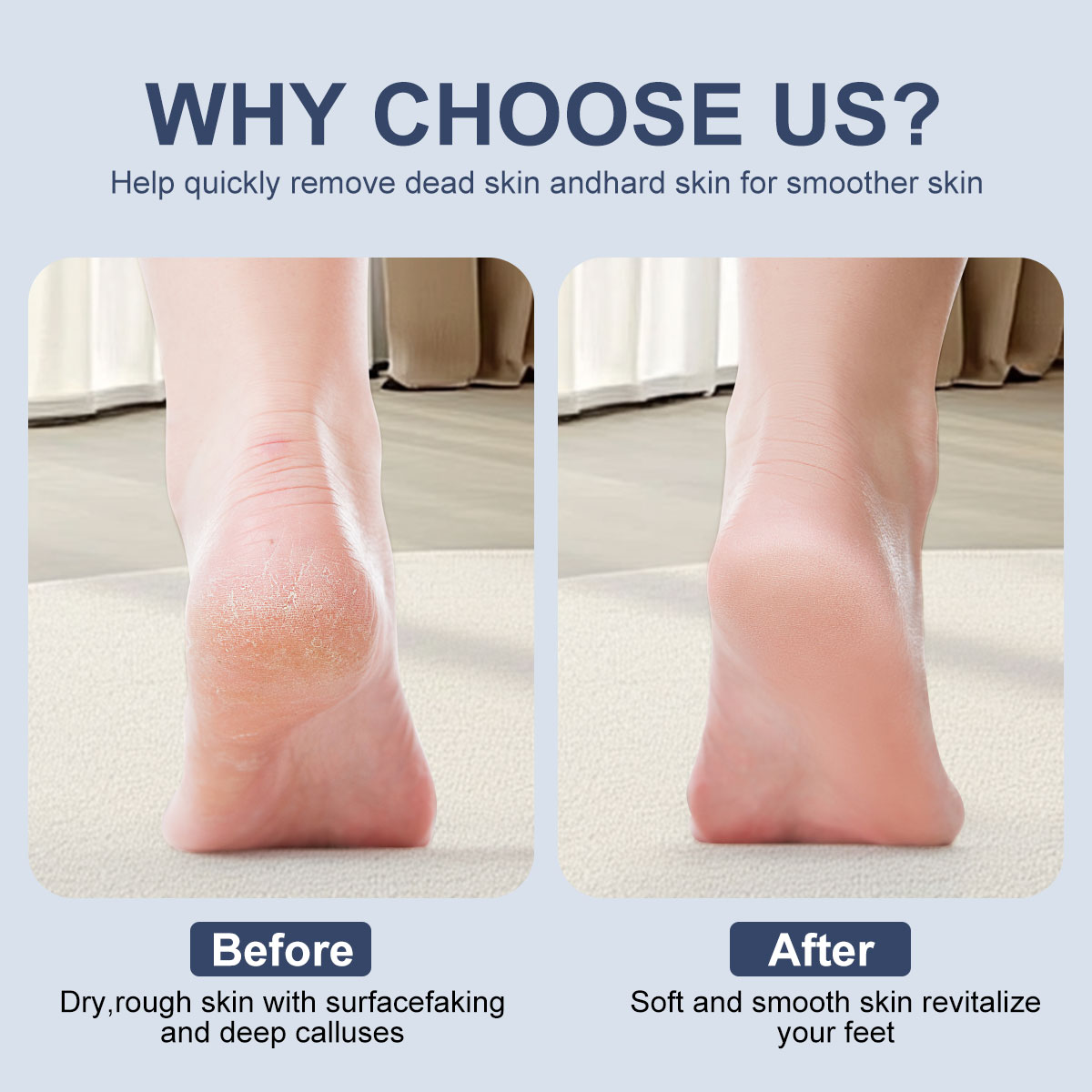 Vacuum Callus Remover – Electric Foot Care Tool